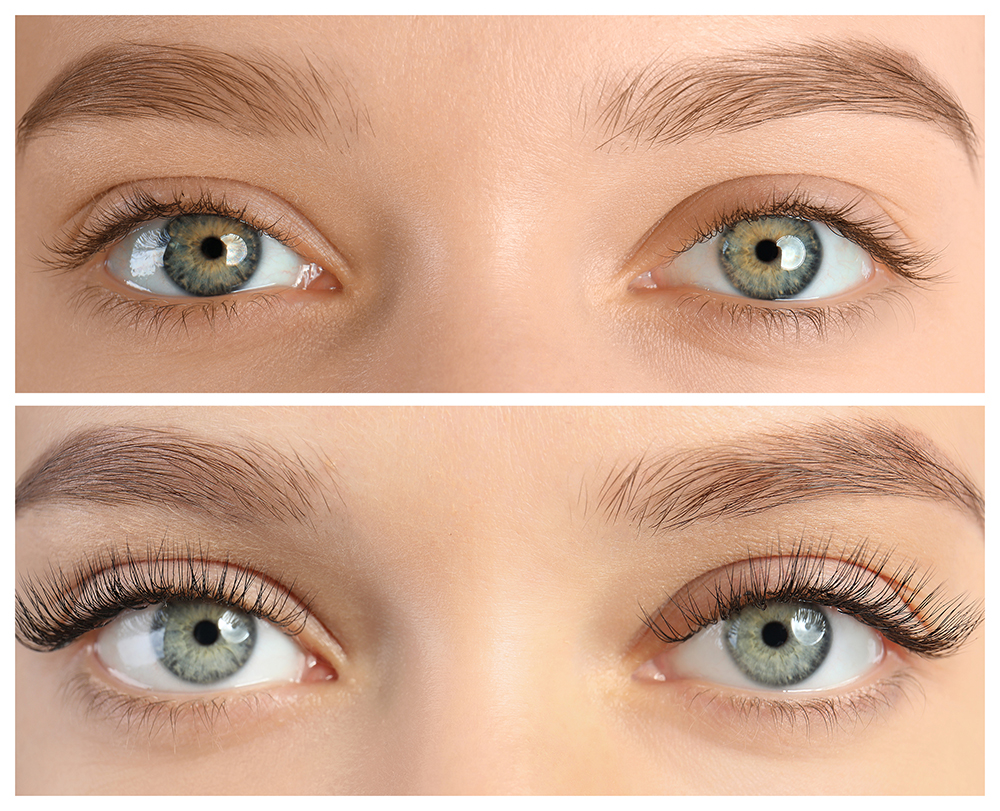 1 Face area that can be helped with Fillers