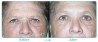 Brow and Forehead Lift Case 071