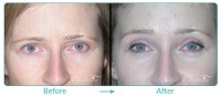 Brow and Forehead Lift Case 091