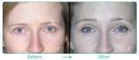 Brow and Forehead Lift Case 091