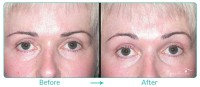 Brow and Forehead Lift Case 11