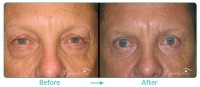 Lower Blepharoplasty Male Case-011