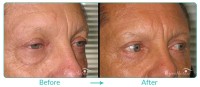 Lower Blepharoplasty Male Case 021