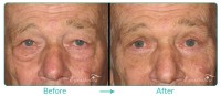 Lower Blepharoplasty Male Case-031