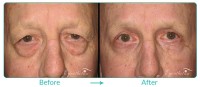 Lower Blepharoplasty Male Case 051