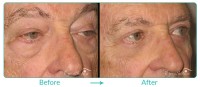 Lower Blepharoplasty Procedure Male Case 091