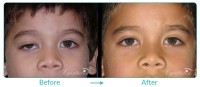 Pediatric Oculoplastic Case-01