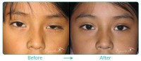 Pediatric Oculoplastic Procedure Case 02