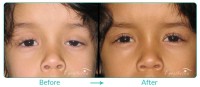 Pediatric Oculoplastic Procedure Case-03