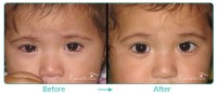 Pediatric Oculoplastic Case-04