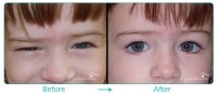Pediatric Oculoplastic Case-05