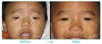 Pediatric Oculoplastic Procedure Case 06