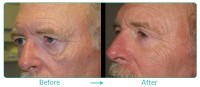 Lower Blepharoplasty Male Case 02