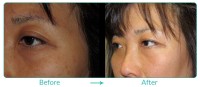 Asian Blepharoplasty Procedure