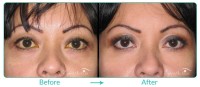 Asian Blepharoplasty