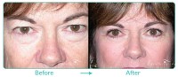 Blepharoplasty Female