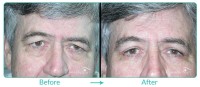 Blepharoplasty Male