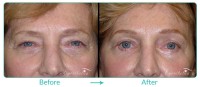 Brow and Forehead Lift