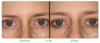 Eyelid Lesion Removal