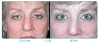 Eyelid Ptosis Repair