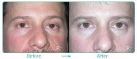 Eyelid Ptosis Repair Case-0411