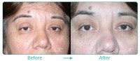 Eyelid Ptosis Repair Case-1111