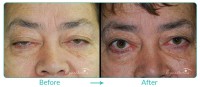 Eyelid Pstosis Repair Case-2111