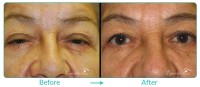 Eyelid Ptosis Repair Case-2411