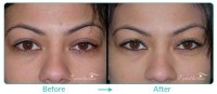 Eyelid Pstosis Repair Case-4211