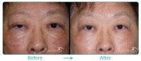 Eyelid Ptosis Repair Case-5011