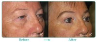 Lower Blepharoplasty, Female