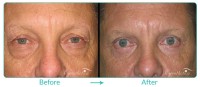 Lower Blepharoplasty Male