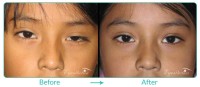Pediatric Oculoplastic