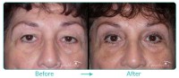 Upper Blepharoplasty Female