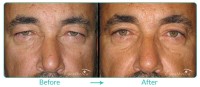 Upper Blepharoplasty Male