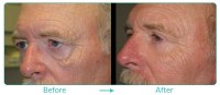 Eyelid Ptosis Repair Case-02