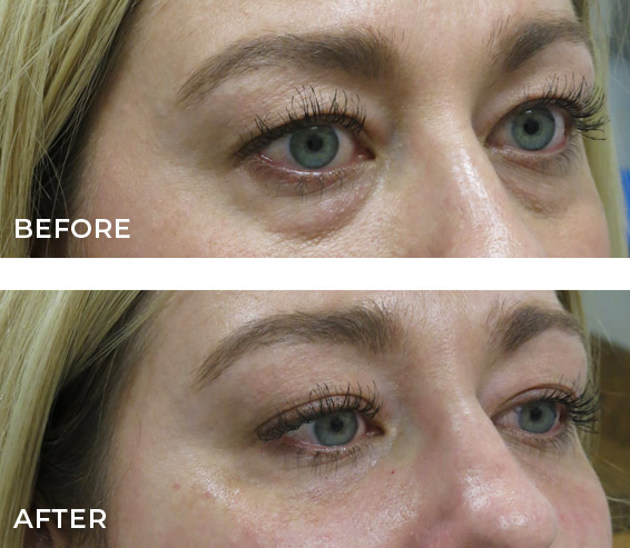 Botox Before and After Results from Plastic Surgeon