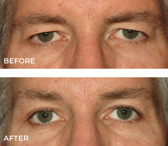 Best Brow Lift Results from Eye Surgery in Encino