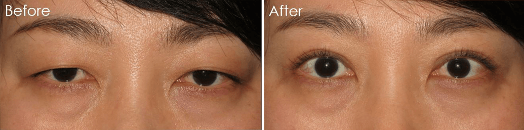 Double Eyelid Surgery