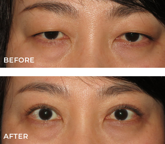 Double Eyelid Surgery Before and After Results