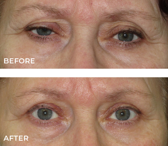 Droopy Eyelid Repair Before and After Results