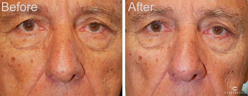 Ectropion Procedure Case-01