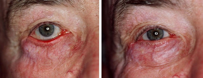 Ectropion Procedure Case-02