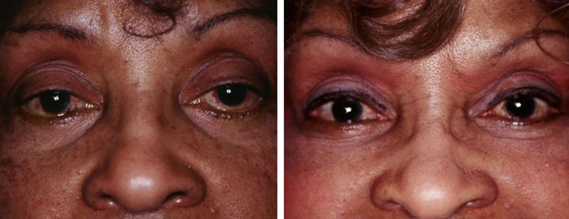 Ectropion Procedure Case-03