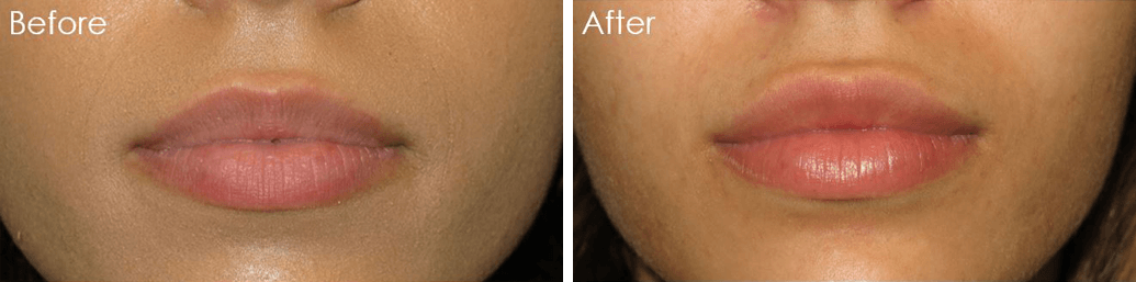 Lip Enhancement Best Results