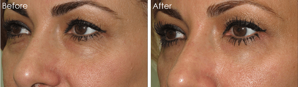 Lower Blepharoplasty Best Results