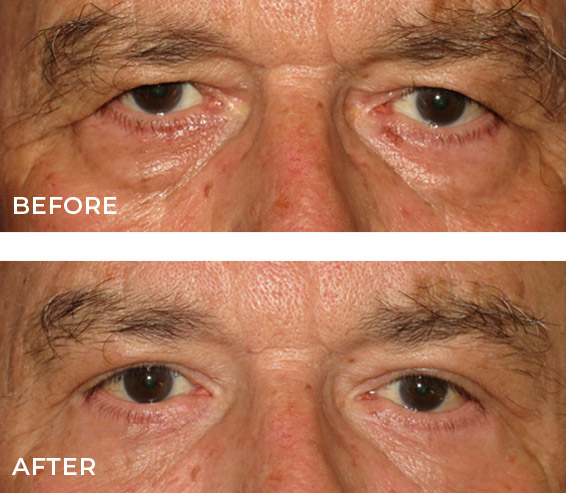 Encino Eye Bag Removal Before and After Results