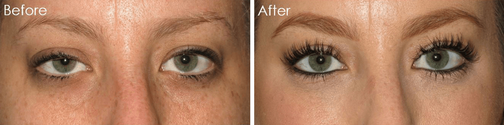 Droopy Eyelid or Ptosis Best Results