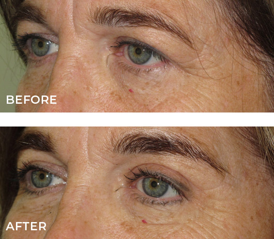 Upper Blepharoplasty Before and After Results