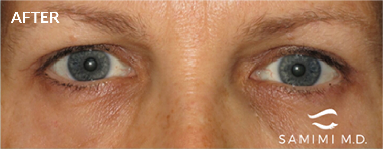 After Blepharoplasty